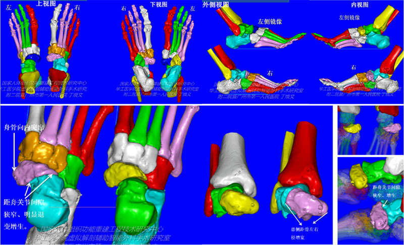骨科診療邁入精準醫療時代，3D技術為骨科手術“保駕護航”